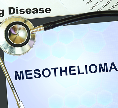 Malignant Pleural Mesothelioma - A Pipeline Analysis Report